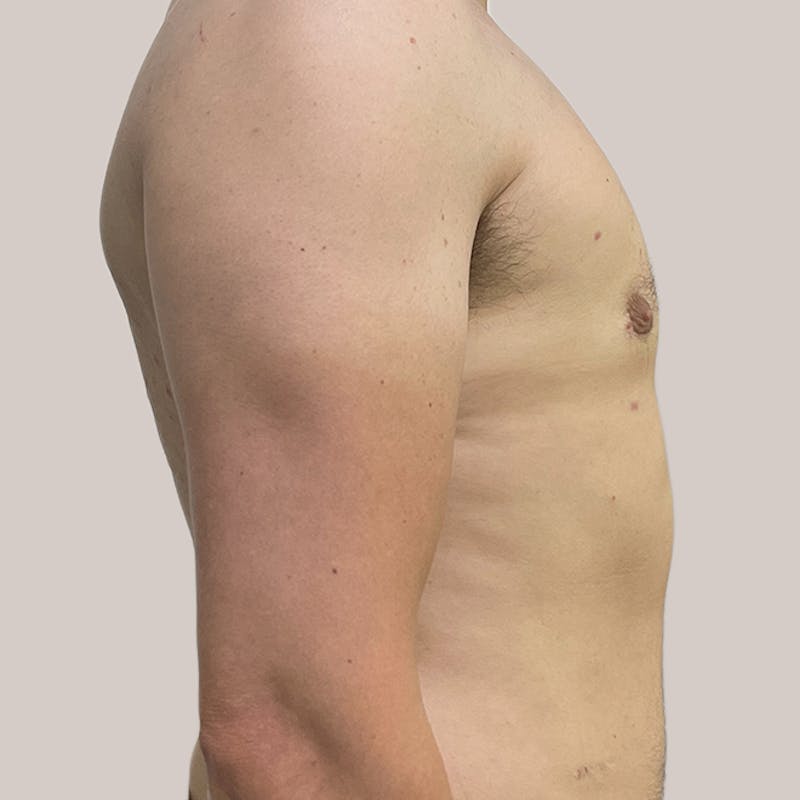 Gynecomastia (Male Breast Reduction) Before & After Gallery - Patient 93812395 - Image 2