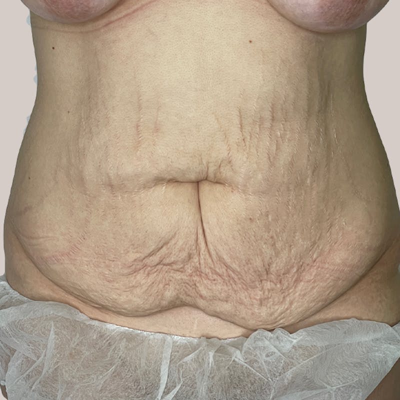 Tummy Tuck Before & After Gallery - Patient 93812599 - Image 1