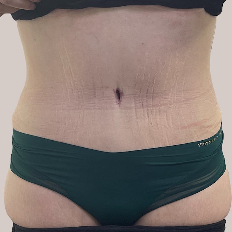 Tummy Tuck Before & After Gallery - Patient 93812599 - Image 2