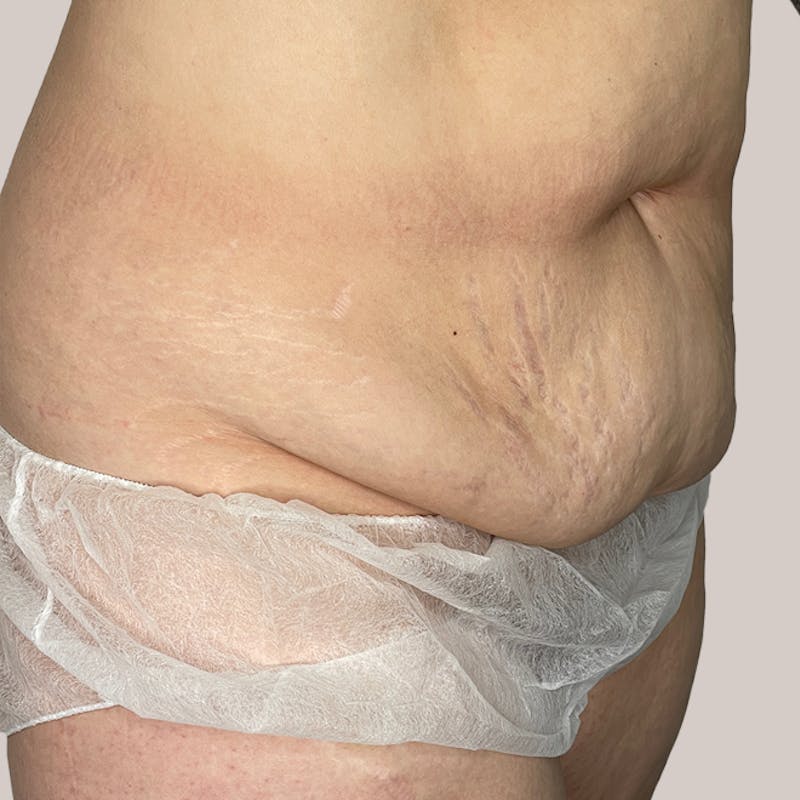Tummy Tuck Before & After Gallery - Patient 93812601 - Image 1