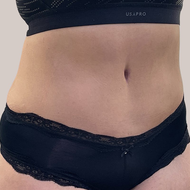 Tummy Tuck Before & After Gallery - Patient 93812601 - Image 2