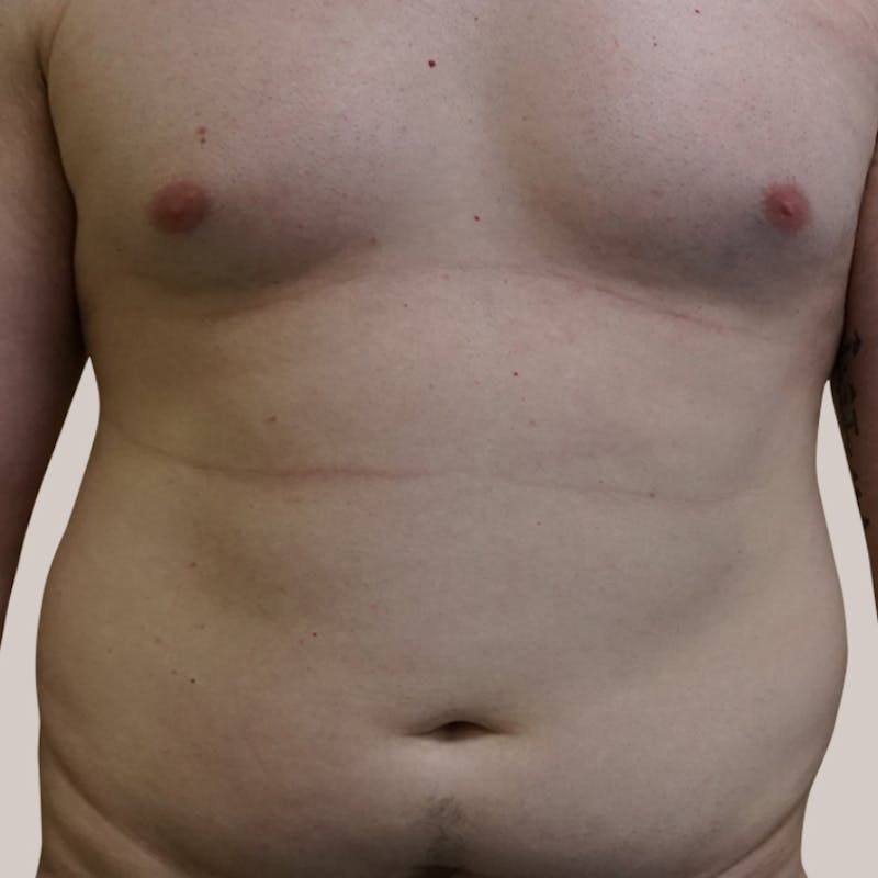 Vaser/Smart Liposuction Before & After Gallery - Patient 93841036 - Image 1