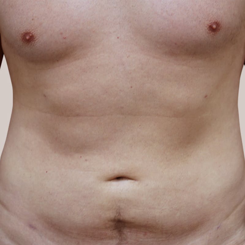 Vaser/Smart Liposuction Before & After Gallery - Patient 93841036 - Image 2