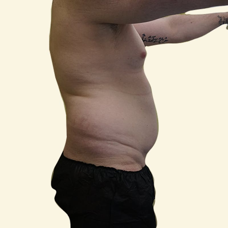 Vaser/Smart Liposuction Before & After Gallery - Patient 93841037 - Image 1