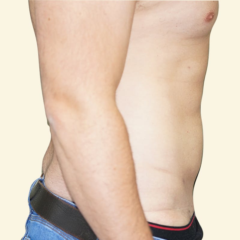 Vaser/Smart Liposuction Before & After Gallery - Patient 93841037 - Image 2