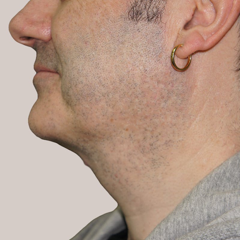 Vaser/Smart Liposuction Before & After Gallery - Patient 93841038 - Image 2