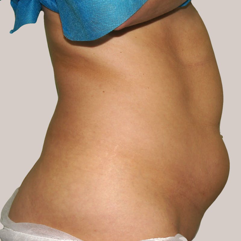 Vaser/Smart Liposuction Before & After Gallery - Patient 93841039 - Image 1