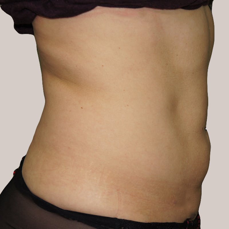 Vaser/Smart Liposuction Before & After Gallery - Patient 93841039 - Image 2