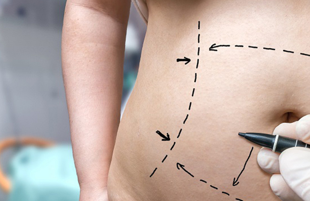 Why a tummy tuck Why a tummy tuck