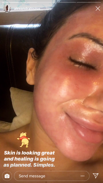 Alexandra Crane Laser Facial Result