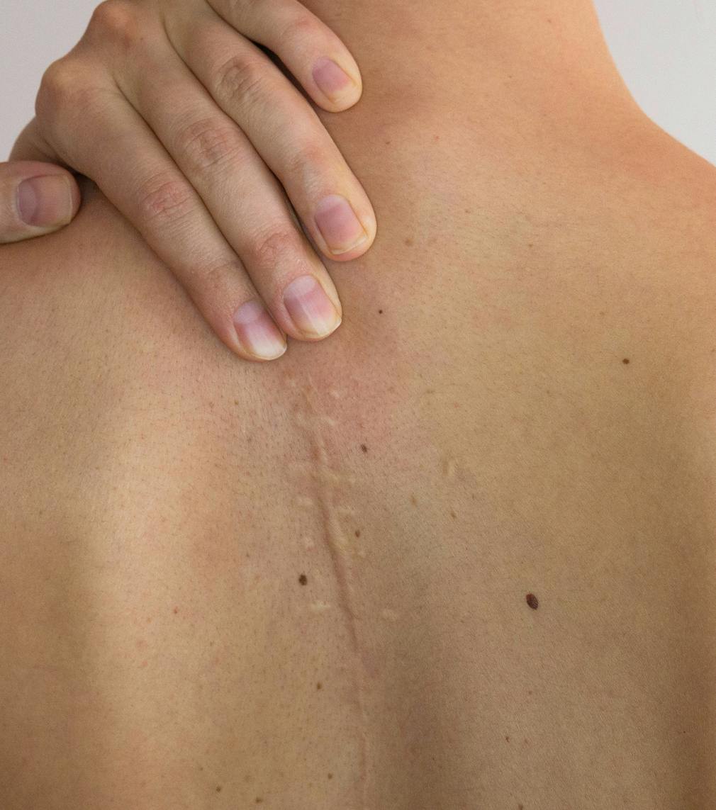 Scar on a persons back