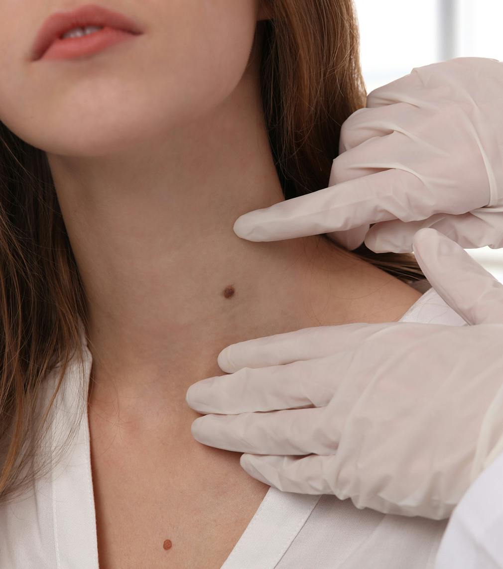 Doctor looking at a mole on a womans neck