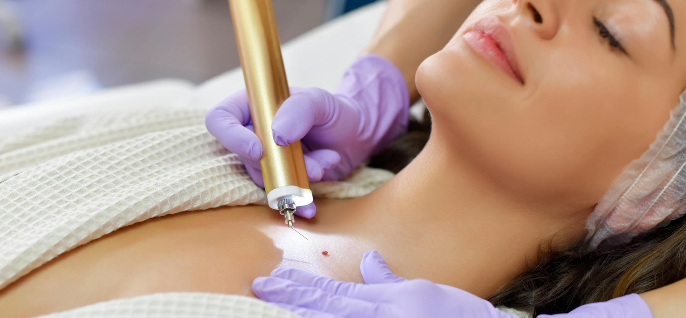 Woman getting a mole removed