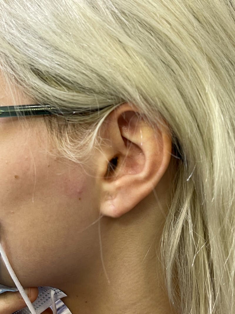 Earlobe Repair Before & After Gallery - Patient 101411073 - Image 2