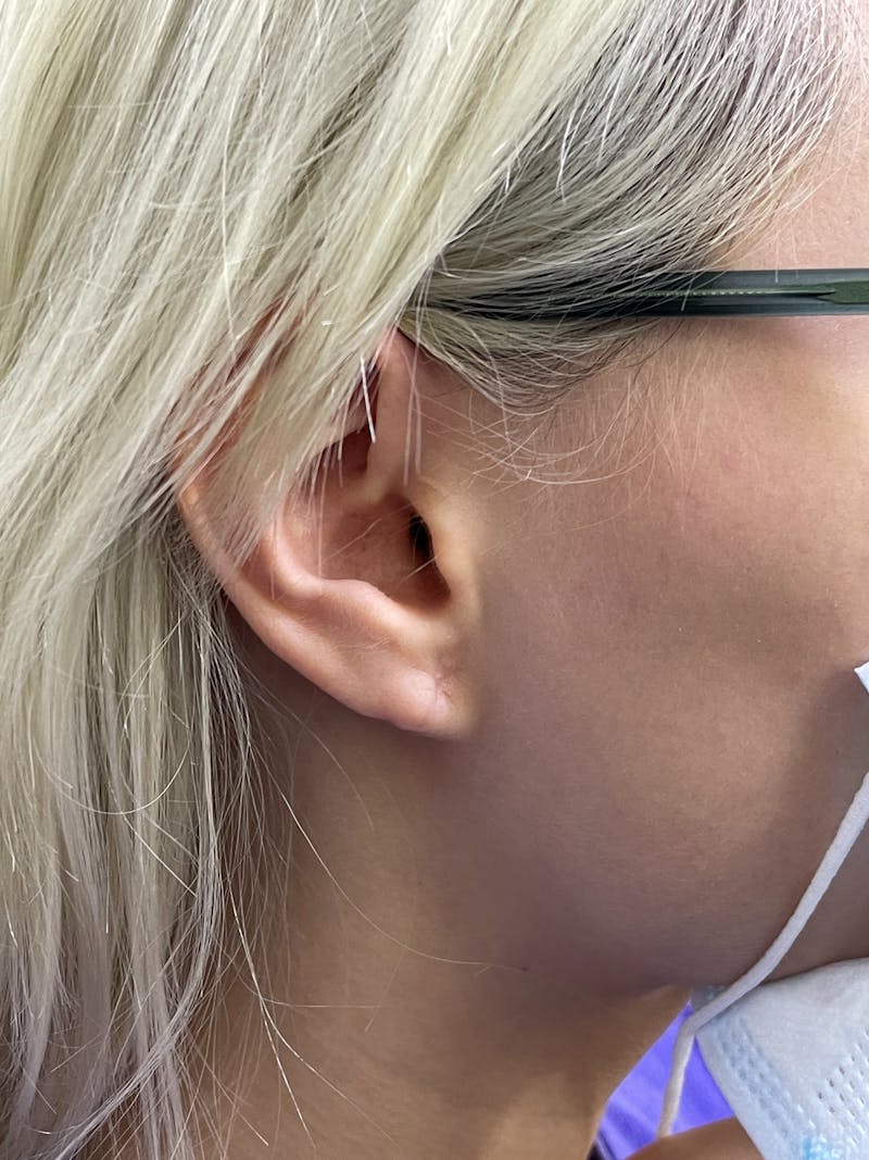 Earlobe Repair Before & After Gallery - Patient 101411073 - Image 4