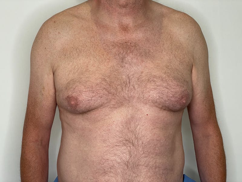 Gynecomastia (Male Breast Reduction) Before & After Gallery - Patient 101411211 - Image 1