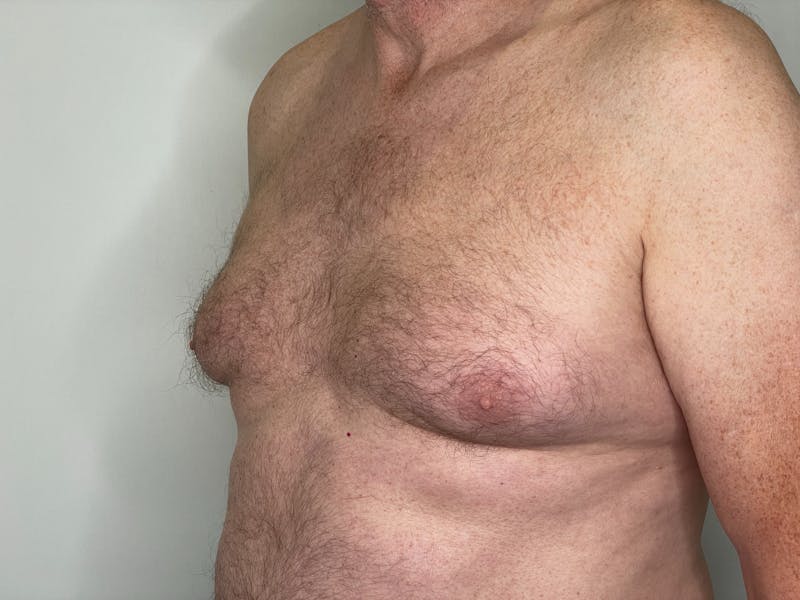 Gynecomastia (Male Breast Reduction) Before & After Gallery - Patient 101411211 - Image 3