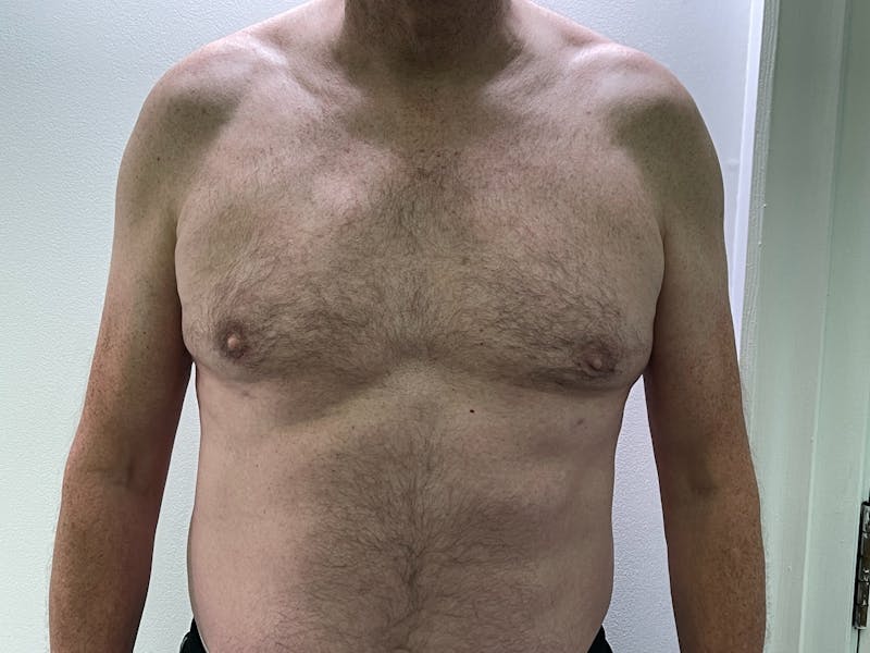 Gynecomastia (Male Breast Reduction) Before & After Gallery - Patient 101411211 - Image 2