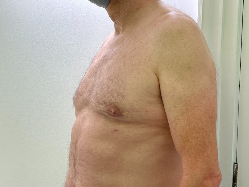 Gynecomastia (Male Breast Reduction) Before & After Gallery - Patient 101411211 - Image 4