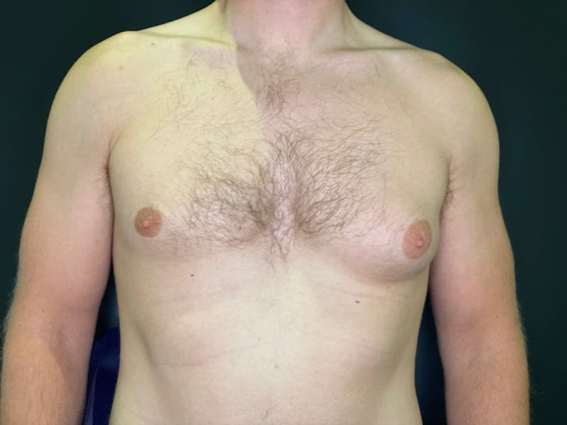 Gynecomastia (Male Breast Reduction) Before & After Gallery - Patient 101411212 - Image 1