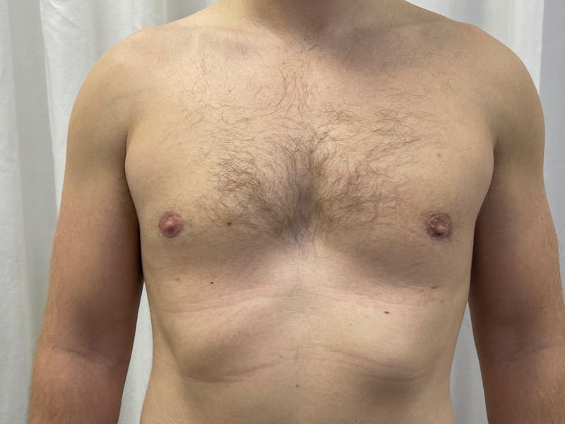 Gynecomastia (Male Breast Reduction) Before & After Gallery - Patient 101411212 - Image 2