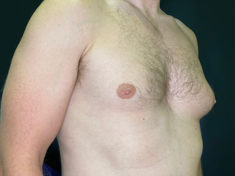 Gynecomastia (Male Breast Reduction) Before & After Gallery - Patient 101411212 - Image 3