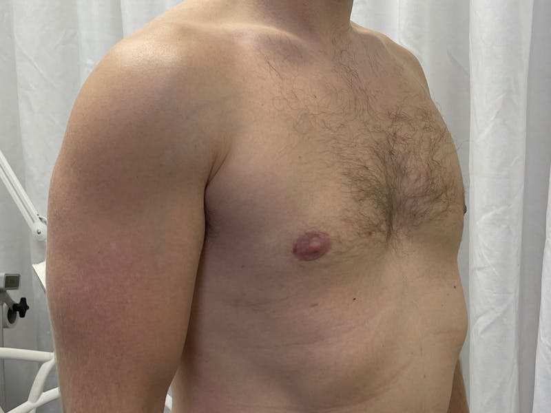 Gynecomastia (Male Breast Reduction) Before & After Gallery - Patient 101411212 - Image 4