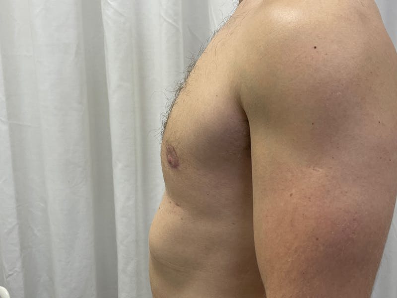 Gynecomastia (Male Breast Reduction) Before & After Gallery - Patient 101411212 - Image 6