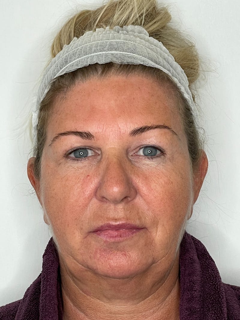 Facelift Before & After Gallery - Patient 101411687 - Image 3