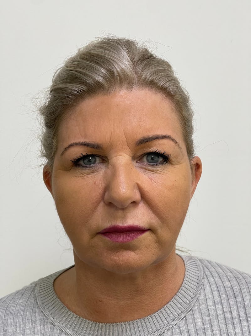 Facelift Before & After Gallery - Patient 101411687 - Image 4