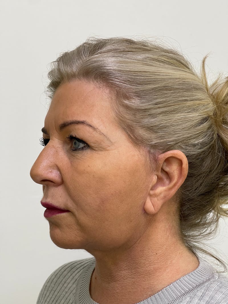 Facelift Before & After Gallery - Patient 101411687 - Image 2