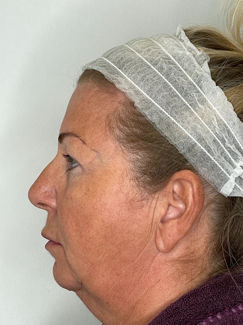 Facelift Before & After Gallery - Patient 101411687 - Image 5
