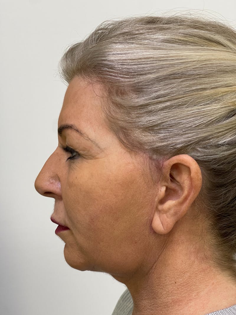 Facelift Before & After Gallery - Patient 101411687 - Image 6