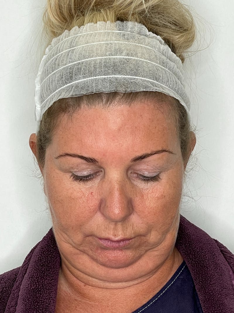 Facelift Before & After Gallery - Patient 101411687 - Image 7