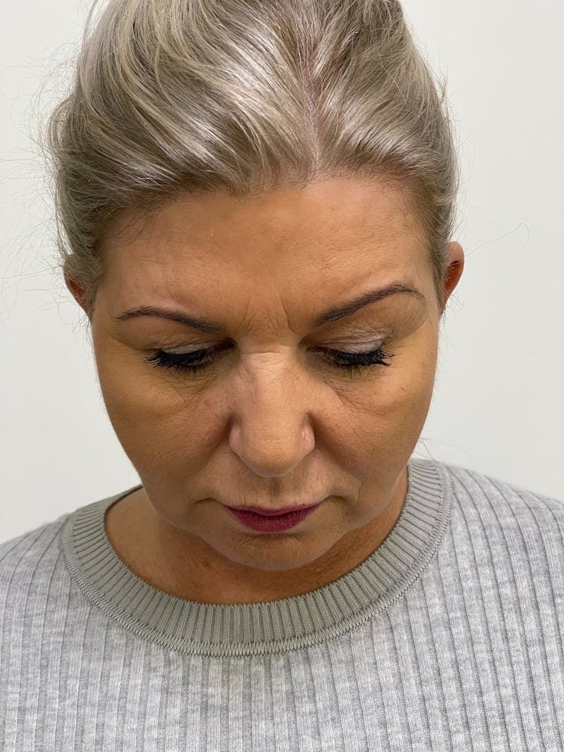 Facelift Before & After Gallery - Patient 101411687 - Image 8