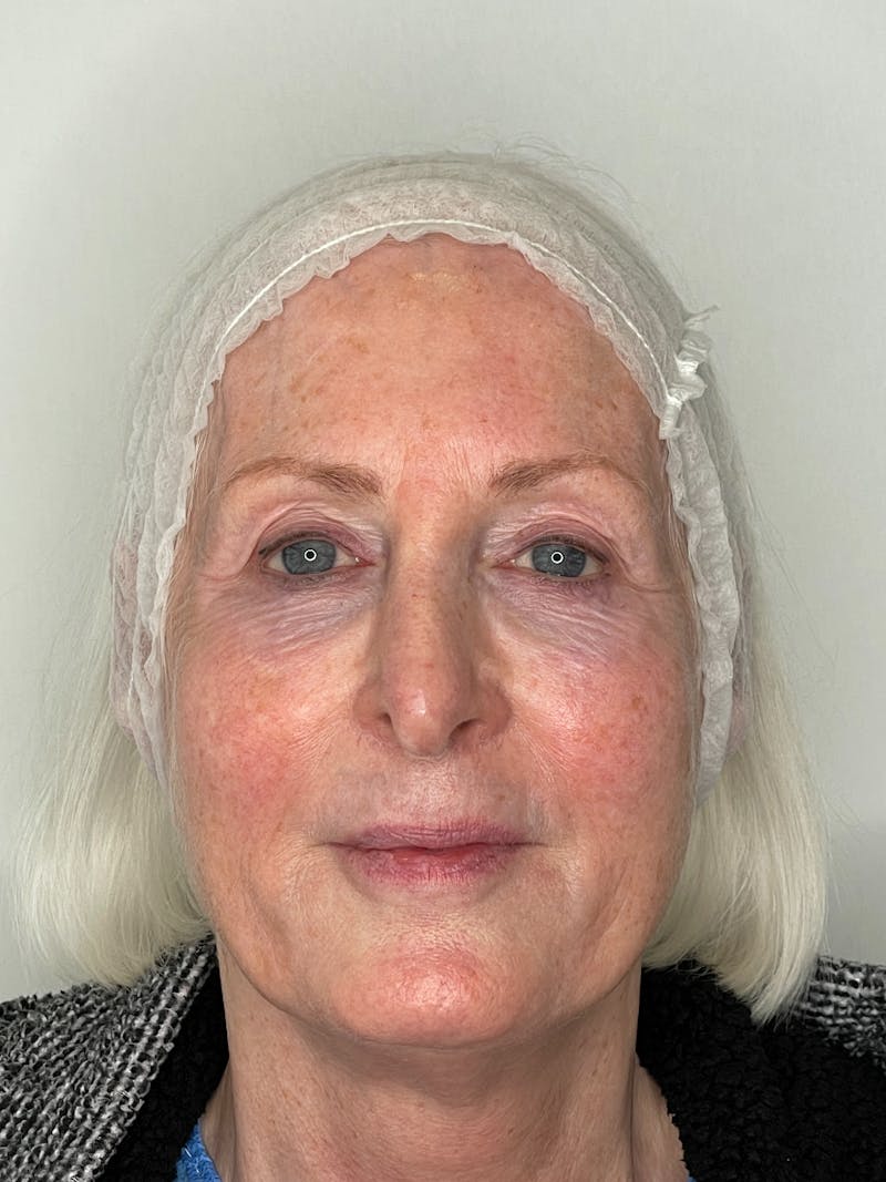 CO2 Laser Resurfacing Before & After Gallery - Patient 101411714 - Image 1