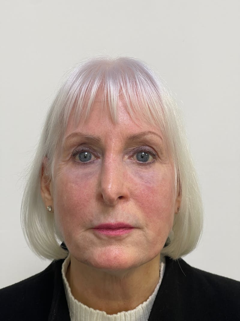CO2 Laser Resurfacing Before & After Gallery - Patient 101411714 - Image 2