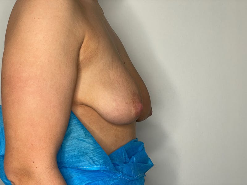 Breast Uplift with Implants Before & After Gallery - Patient 101680570 - Image 3