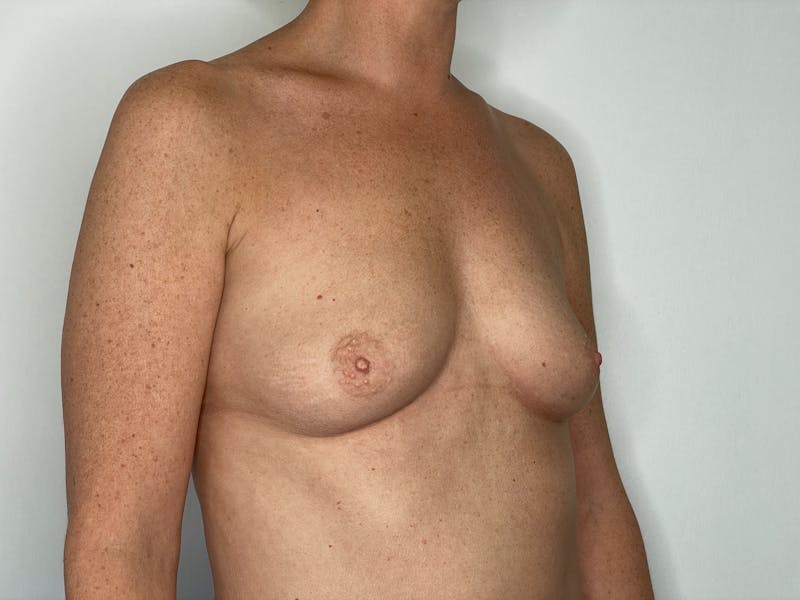 Breast Augmentation Before & After Gallery - Patient 101411922 - Image 1