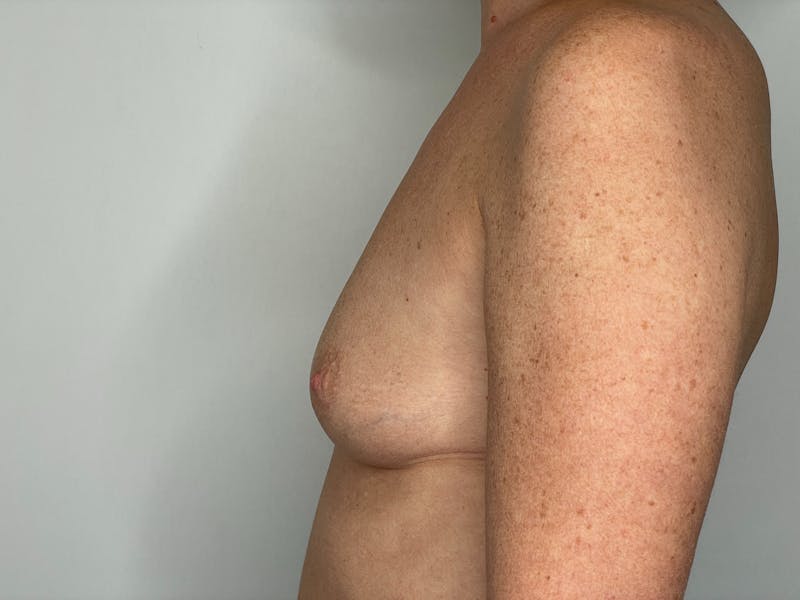 Breast Augmentation Before & After Gallery - Patient 101411922 - Image 3
