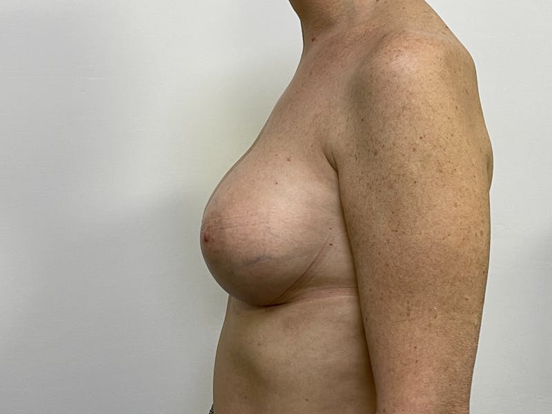 Breast Augmentation Before & After Gallery - Patient 101411922 - Image 4