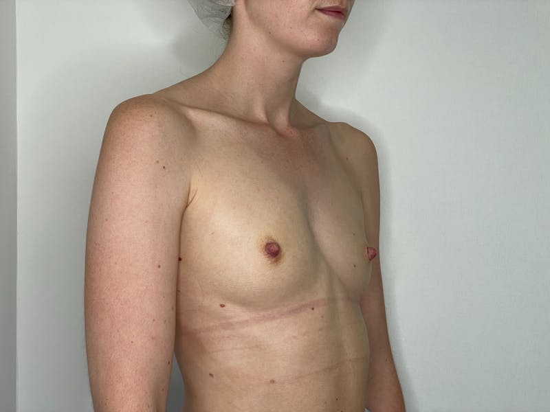 Breast Augmentation Before & After Gallery - Patient 101412194 - Image 1