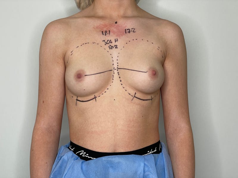 Breast Augmentation Before & After Gallery - Patient 101412195 - Image 1