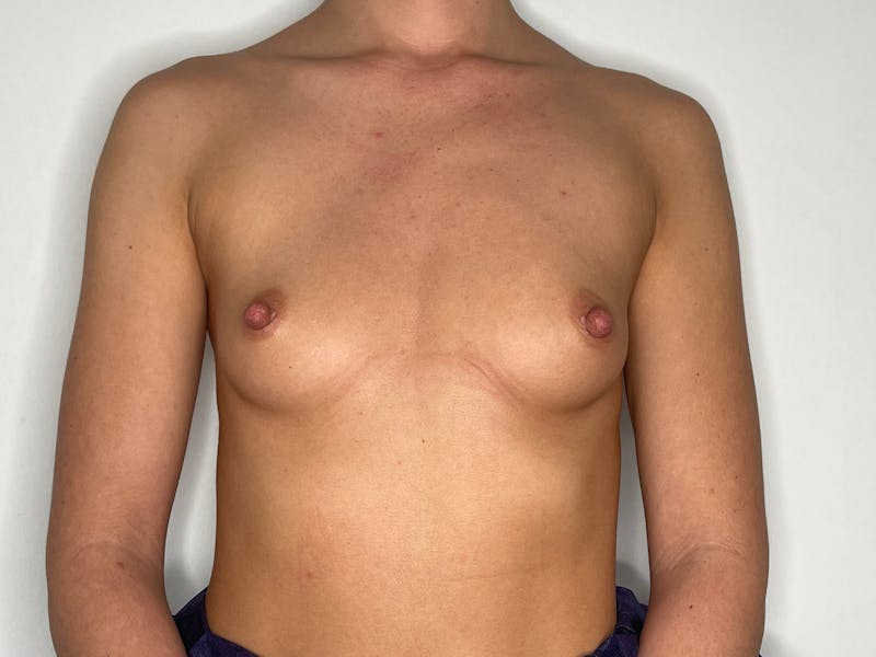 Breast Augmentation Before & After Gallery - Patient 101412257 - Image 1