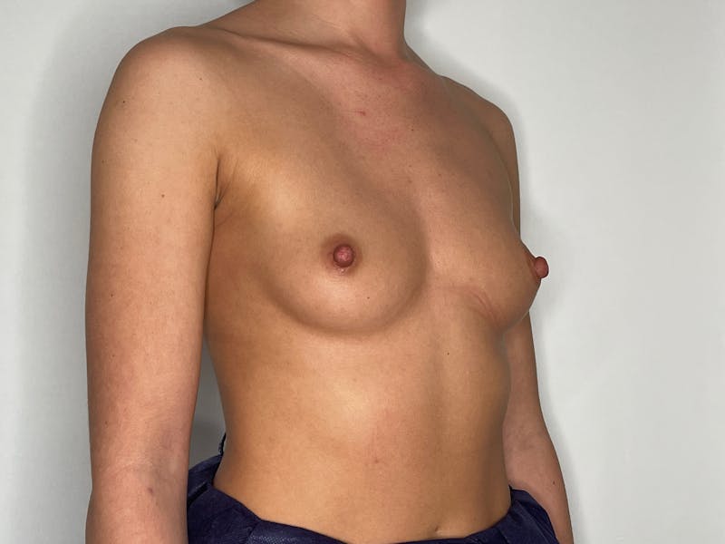 Breast Augmentation Before & After Gallery - Patient 101412257 - Image 3