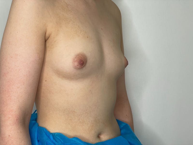 Breast Augmentation Before & After Gallery - Patient 101412258 - Image 1