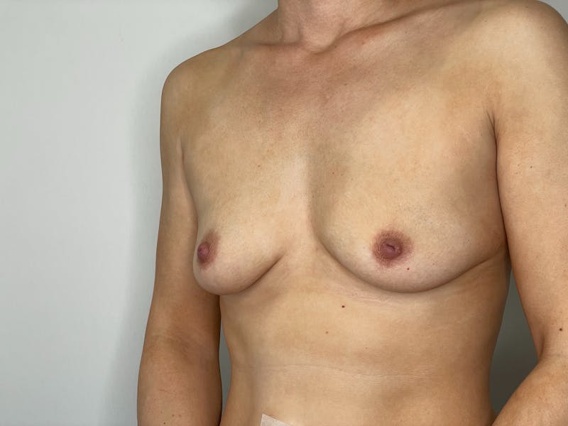 Breast Augmentation Before & After Gallery - Patient 101412259 - Image 1