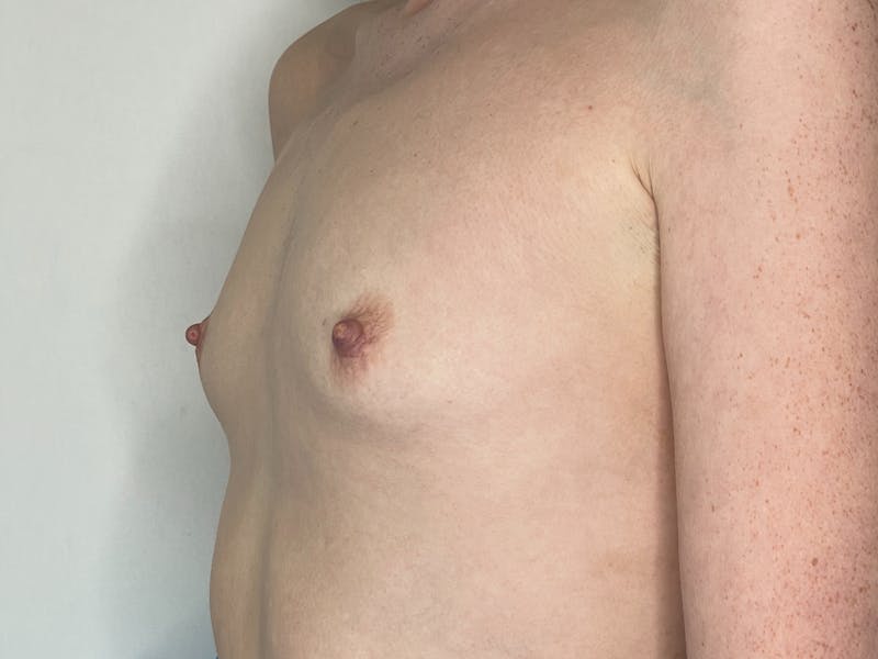 Breast Augmentation Before & After Gallery - Patient 101412255 - Image 1