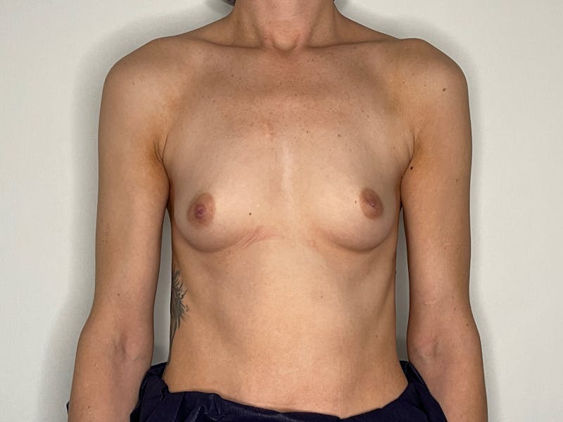 Breast Augmentation Before & After Gallery - Patient 101412261 - Image 1