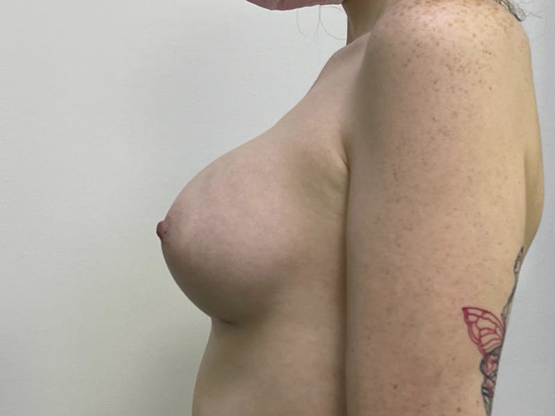 Breast Augmentation Before & After Gallery - Patient 101412255 - Image 6